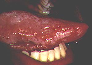 Spot The Diagnosis Of These Tongue Lesions